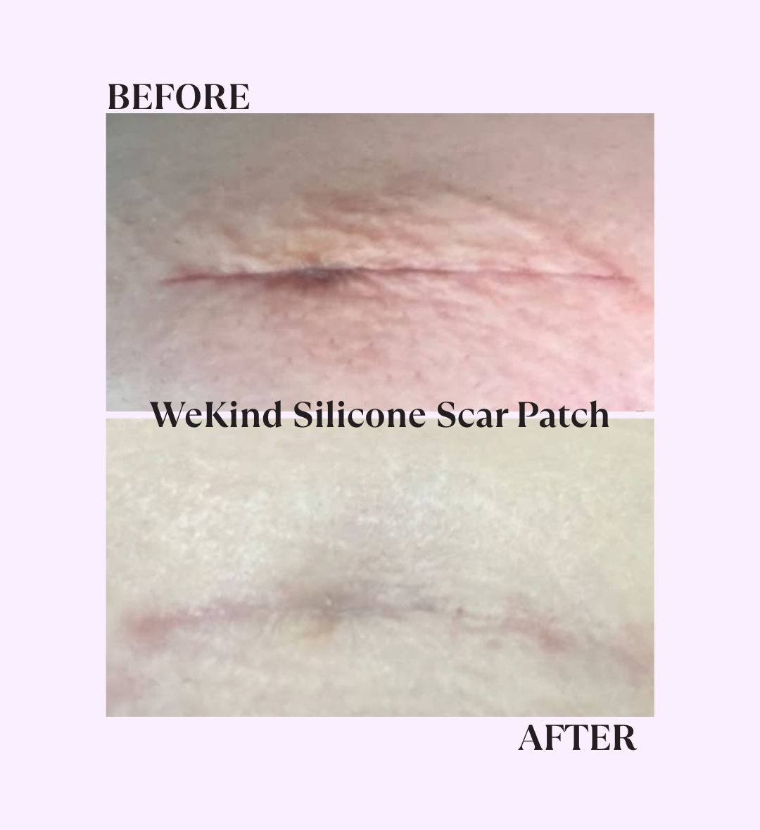 Silicone Scar Patch (pack of 3)